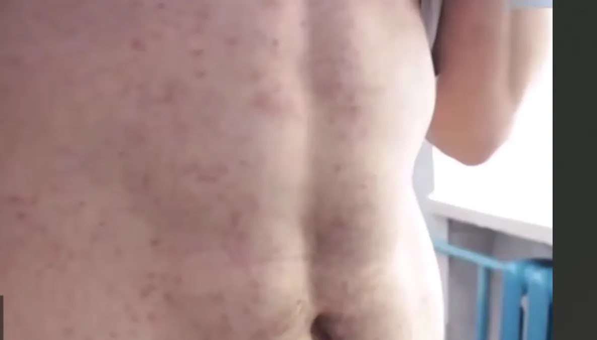 В Хабаровске жители целого подъезда многоэтажки заболели корью