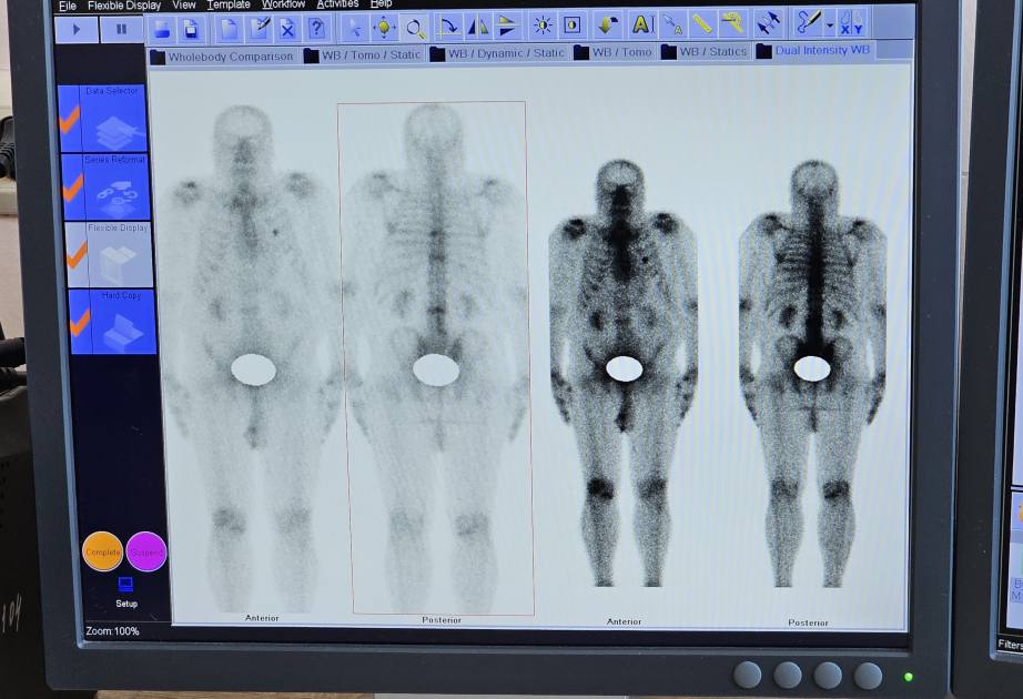 Более 70 пациентов прошли лечение радиоактивным йодом в краевом онкоцентре в 2025 году Более 70 пациентов прошли лечение радиоактивным йодом в краевом онкоцентре в 2025 году
