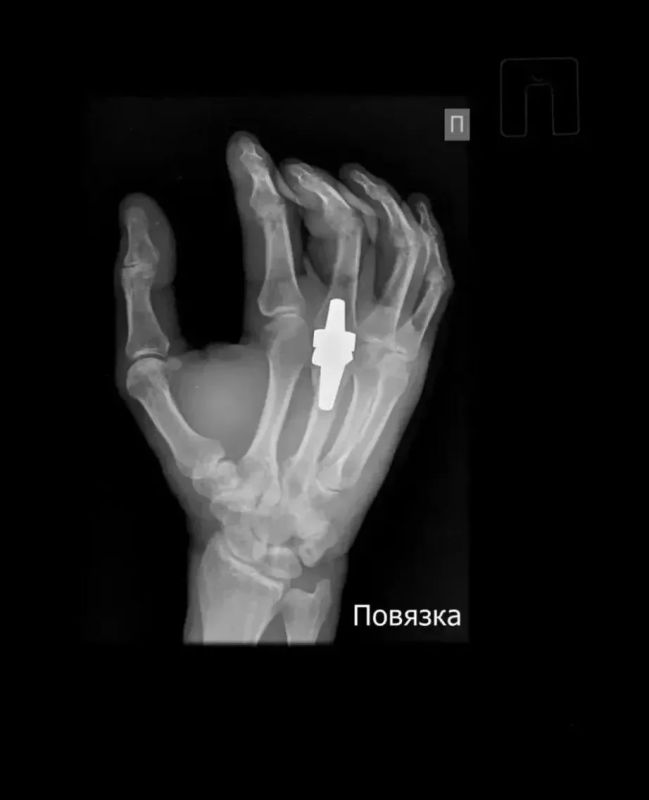 Подвижность кисти руки вернули хабаровские хирурги бойцу спецоперации Подвижность кисти руки вернули хабаровские хирурги бойцу спецоперации